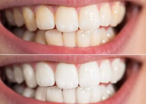 HT13. Natural Teeth Whitening at Home: Can Simple Ingredients Help Brighten Your Smile?