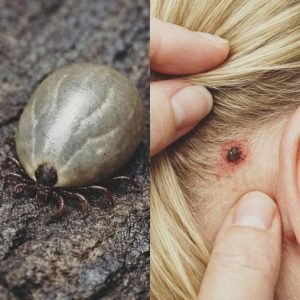 HT4. Found a Weird Bug in Your Child’s Hair? Important Info for Parents