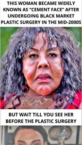 ST5. “She Was Injected With Cement — See Her Shocking Transformation 14 Years Later!”