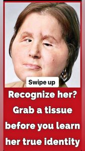 ST5. The amazing story of Katie Stubblefield: She became the youngest person to receive a face transplant