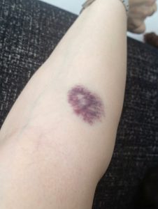 HT9. THE SILENT KILLER ON YOUR SKIN: Why Those Mysterious Bruises Are Screaming for Your Attention
