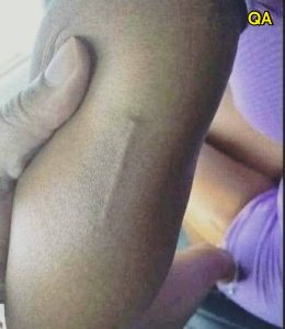 HT13. Something Appeared on My Daughter’s Arm and I Had No Idea What It Was