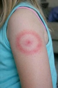 HT9. My Child Has a Ring-Shaped Rash: Common Causes, Home Care, and When to Call the Doctor