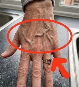 HT9. What Bulging Veins Can Mean