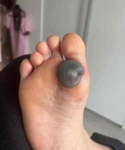 HT9. Terrifying Dark Spot On Your Child Foot Might Be A Medical Nightmare You Are Ignoring