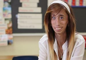 Lizzie was mocked for her looks her entire life, but she is fighting back with optimism