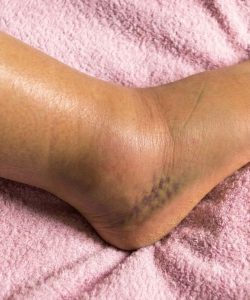 HT9. The Silent Danger Beneath Your Skin: Why Your Swollen Legs Are Screaming for Help