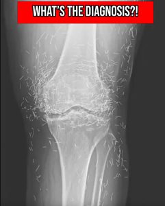 HT9. A 65-year-old woman went in for knee pain, leaving doctors in disbelief after X-ray revelation