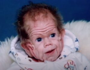 ST5. In 1993, This Boy Was Born With Enough Skin For A Five-Year-Old. But Wait Till You See Him Today