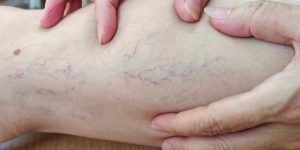 HT5. If you have purple veins on your legs, it means you are…