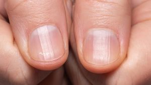 HT5. If You Notice These Lines on Your Nails After 40, Here’s What It Really Means