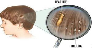 HT5. Head lice: How to get rid of them and stop them coming back