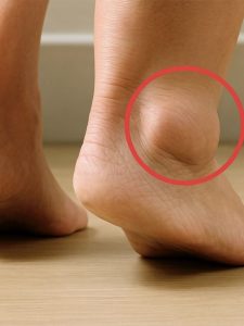 HT9. Swollen Legs: Understanding the Symptoms, Causes, and Treatments