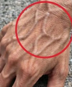 HT10. If you have visible veins, it means you are….
