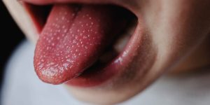 HT5. If you have pimples on your tongue, your body is warning you about something very important