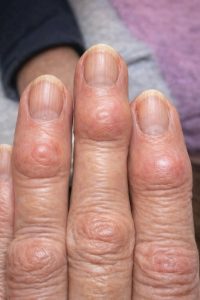 HT10. The Terrifying Truth Behind the Mysterious Hard Bumps Spreading Across Your Hands