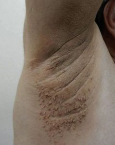 HT5. The Shocking Secret Behind Dark Neck Patches: The Deadly Health Warning Hiding on Your Skin