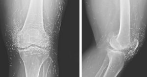 HT9. Doctors find “gold mine” in woman’s knees