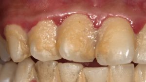 HT5. Be careful!! This is what your teeth will become when you eat…