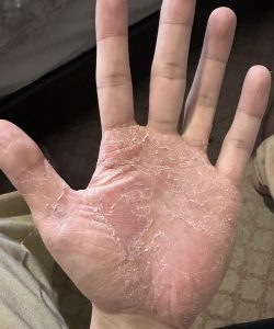 HT9. What Changes in Your Hands Could Be Telling You About Your Skin Health
