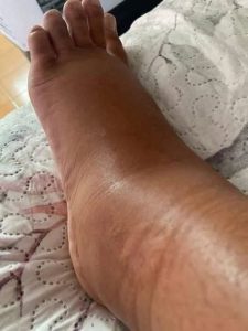 HT5. If your feet swell, it is a clear sign that…