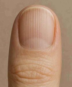 HT9. If you have lines on your nails, it means you have ca…See more