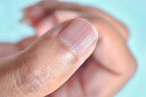 HT5. What Vertical Lines on Your Nails Can Reveal About Aging