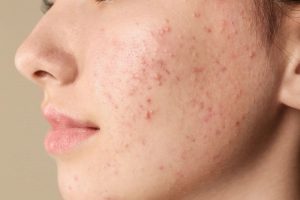 ST5. Body Acne: 5 Tips To Get Rid Of Them