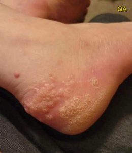 HT7. These are the consequences of wearing used… –