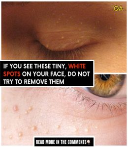 HT5. How to Safely Remove Milia