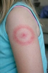 HT9. The Red Ring of Terror: Is Your Child’s Mysterious Rash a Harmless Bug Bite or a Life-Changing Diagnosis?