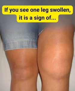 HT5. If you see one leg swollen, it is a sign of…