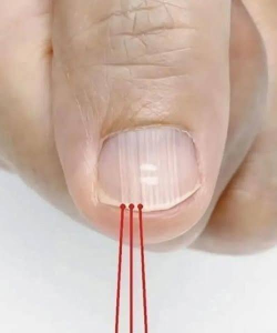 HT9. If you have these lines on your nails after 40, it is a clear sign that..