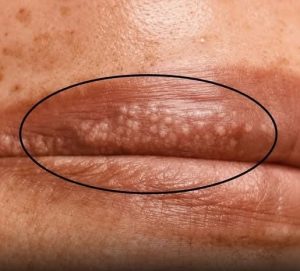 HT9. Those White Spots Might Be Trying To Tell You Something…