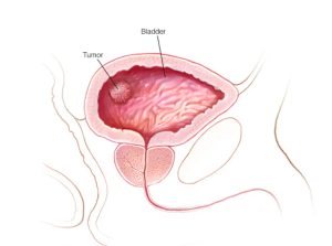 HT5. Before diagnosis, bladder cancer survivors all shared this single most common early sign –