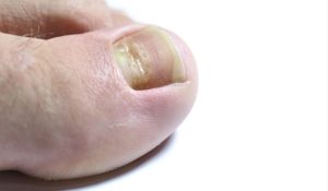 HT5. Health Issues Hidden in Your Nails, Revealed by Doctors