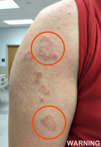 HT5. If you see red marks appearing on your arm, that’s a sign of ca…