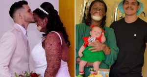 HT7. Woman with rare skin condition overcomes negativity and finds true love
