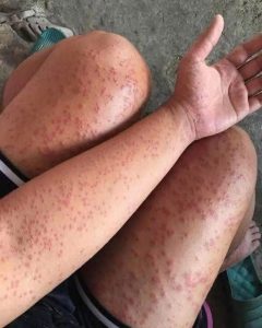 HT5. Skin Rash With Breathing Trouble? It Could Be a Life-Threatening Allergic Reaction